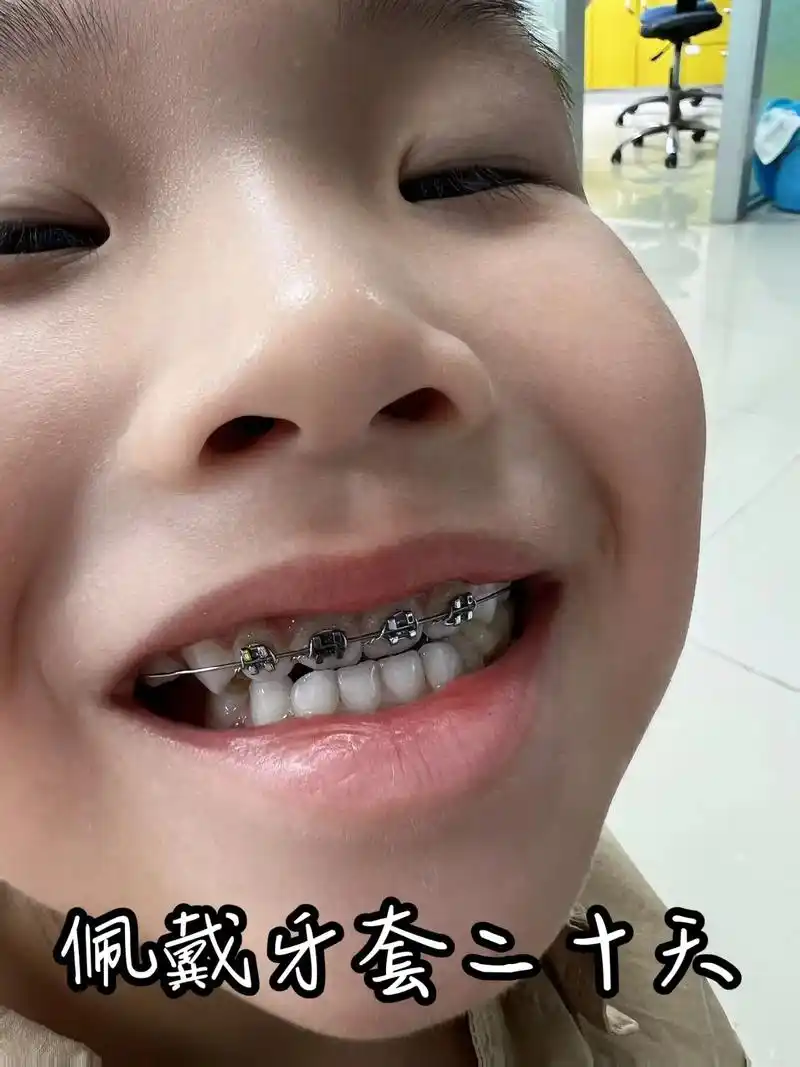 牙齿纠正07.#牙齿07 #牙齿矫正 #带牙套牙套的日子   - 抖音