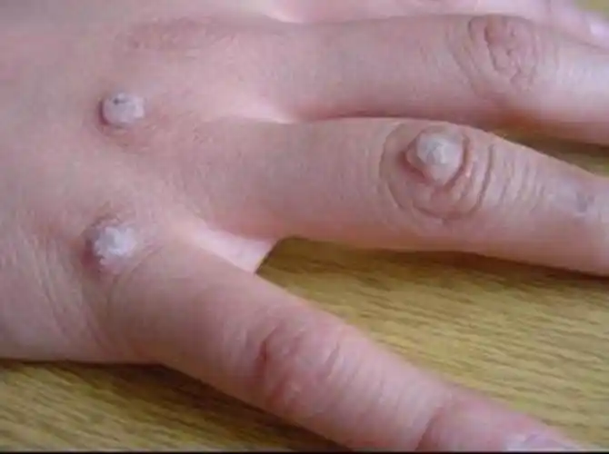 丝状疣的对比图片