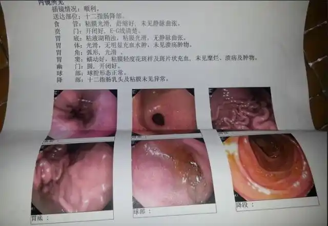 慢性浅表性胃炎严不严重该怎么治疗内科医生终说出大实话