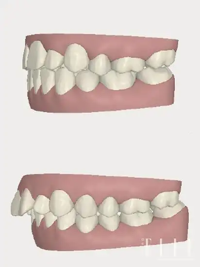 正确咬合(上)错误咬合(下)