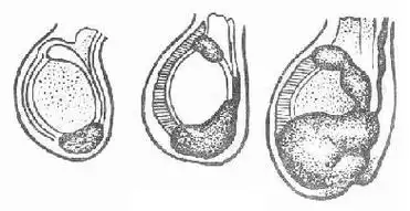 宝宝的蛋蛋一大一小,可能是鞘膜积液