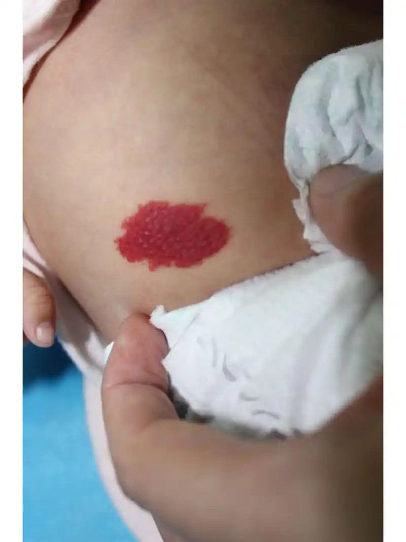 两句话告诉你什么是草莓状血管瘤 8215随婴儿成长而增大,数月内