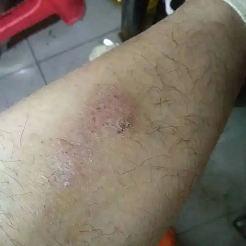 小腿外侧有一块痒是怎么回事,而且越挠越痒