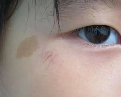 咖啡斑是比… - 知乎