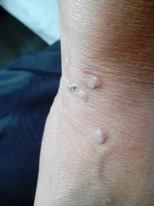 问:扁平疣俗称猴子,在我发现到现在有十几年了,面部也很多,有什么治疗