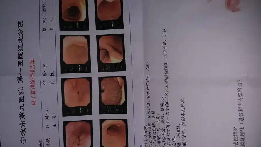 胃窦粘膜隆起灶,胃胀是这个引起的吗