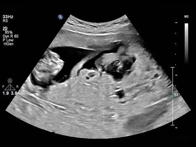 专家门诊1例——双胎合并葡萄胎