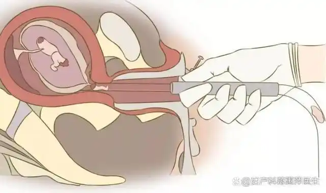 图片来源网络1,无痛人工流产:无痛人工流产可简单理解为人工流产手术