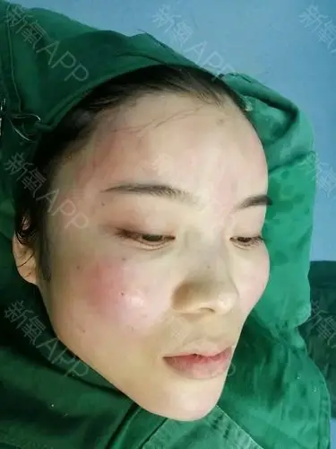 自体脂肪填充泪沟