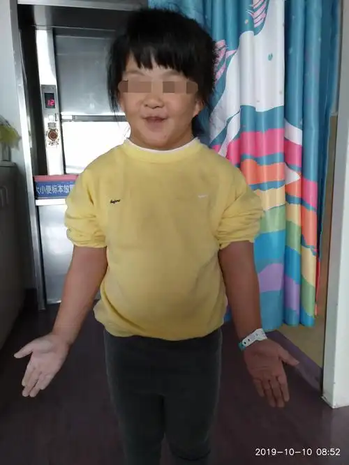 特纳综合征典型病例