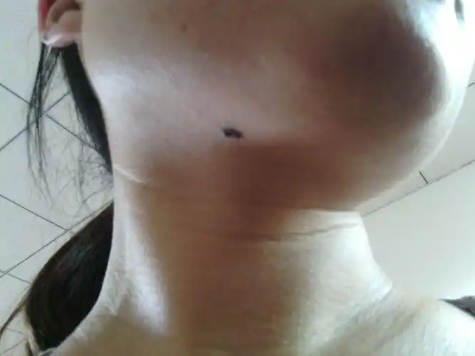 获得性太田痣图片