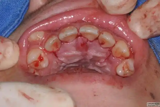 一例埋伏多生牙拔出腭侧开窗