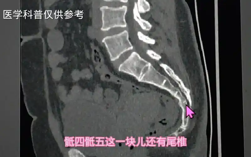 屁股蹲在地上要小心这种骨折---骶尾椎骨折,医生带你从片子上认识它