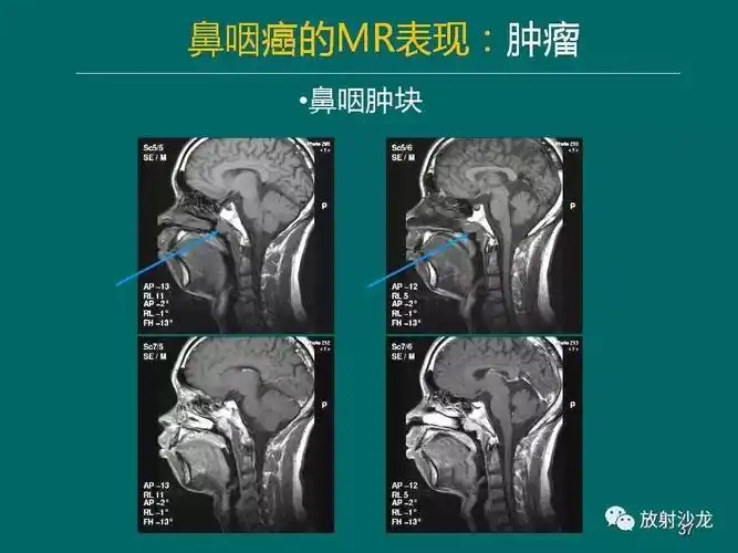 鼻咽癌的mri诊断