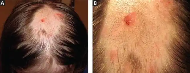 儿童拔毛癖一例