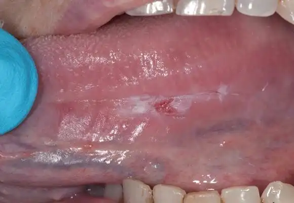 咽部肿瘤图片_咽部肿瘤症状表现图片大全_有来医生