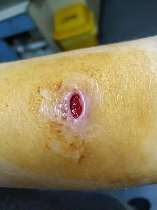 切口换药自身对照