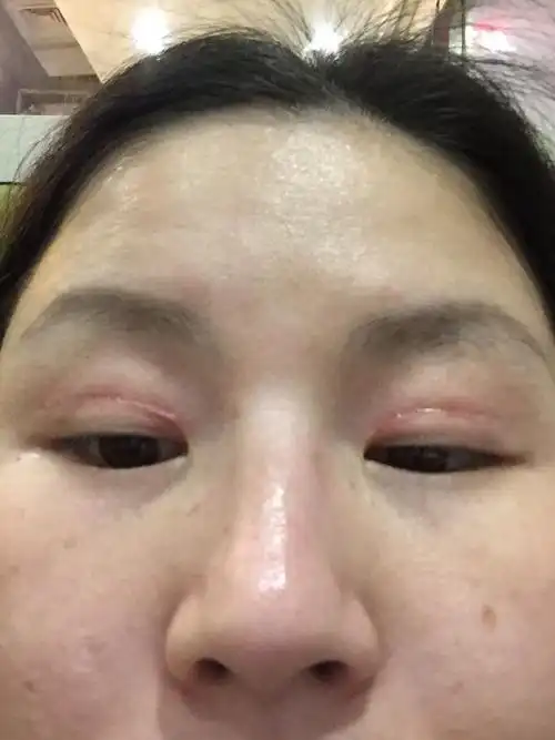 切双眼皮疤痕增生了什麼办?