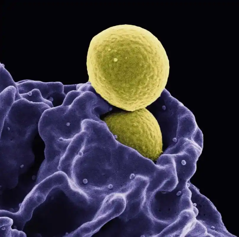 电子显微镜下,白细胞正在吞噬黄色葡萄球菌