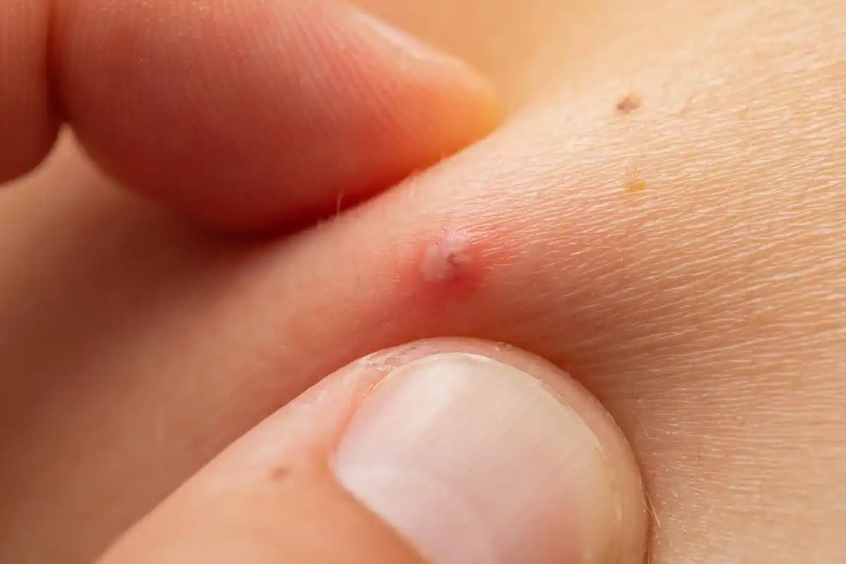 大腿上起红色的小疙瘩很痒	一般来说,大腿上起红色的小疙瘩很痒可能是