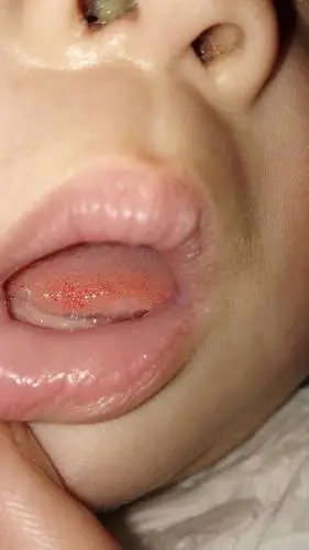 四个月宝宝舌尖通红红点怎么回事