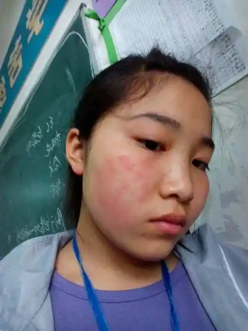 症状由于这种皮肤病常在桃花开放的春季发生,人们俗称为"桃花癣"这种