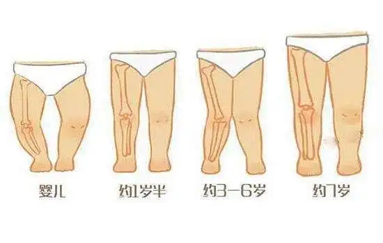 儿童膝内翻与膝外翻什么情况下保守治疗?什么情况下手术治疗?