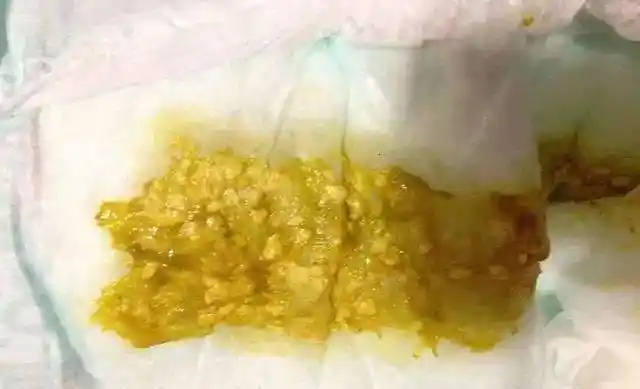 如果宝宝的大便出现豆腐渣样,而且颜色为黄绿色且带有黏液时,大多是