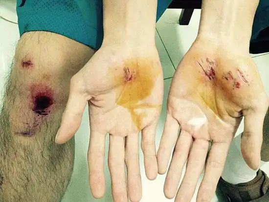 徐正曦《卫子夫》受伤照曝光 多处缝针粉丝心疼