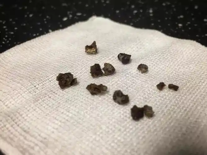 疼到满地打滚,有小便却出不来,一查竟是……这种习惯要改!_结石