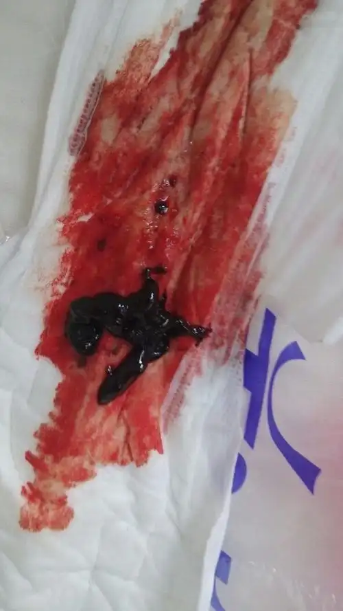 这是流出的胚胎了吗?