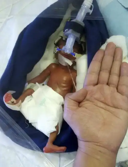 印度"巴掌女婴"奇迹生存:出生时仅0.8斤