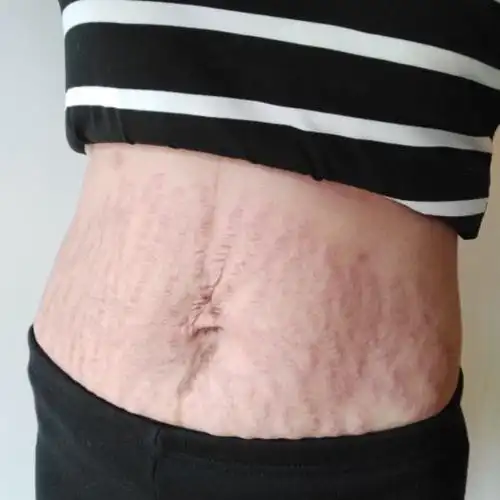 【 去妊娠纹 第一天 】刚生完二宝50天,光荣的完_圈子-新氧美容整形