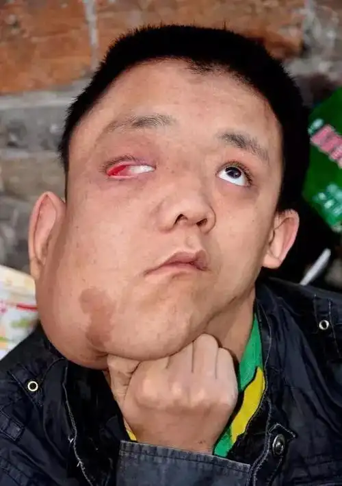 退学收废品治脸   说的是南阳淅川因脸部血管瘤造成脸部畸形的孩子古