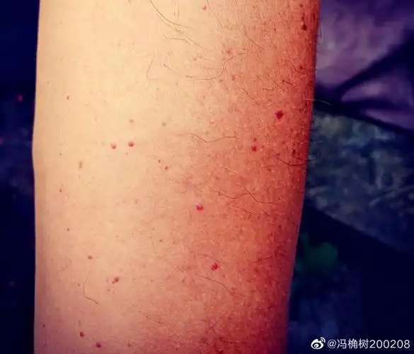 中医药深入探讨全身散播性毛细血管瘤αngiomαtous