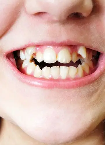 孩子牙齿不齐的3大原因