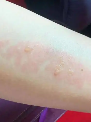 海盐一女生被这"温暖杀手"给烫伤!冬季高发!