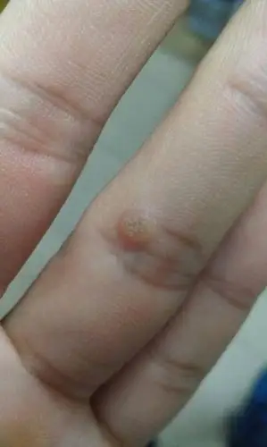 手上长了这样一个东西.要怎么才能弄掉?