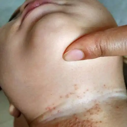 夏天宝宝生痱子怎么办