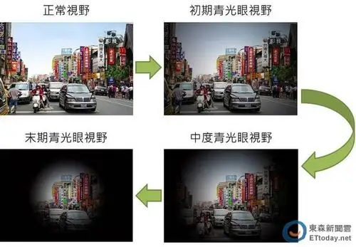 初期8成患者无症状 一张图看懂「青光眼三时期」视野
