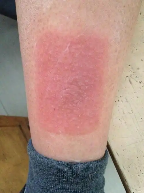 典型病例------接触性皮炎