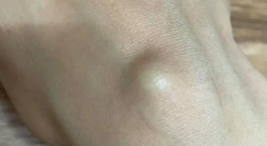 这腱鞘囊肿没完没了