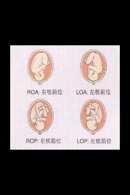 胎位loa是什么位置胎位loa好顺产吗