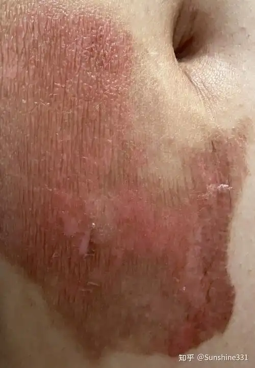 二度烫伤恢复过程记录