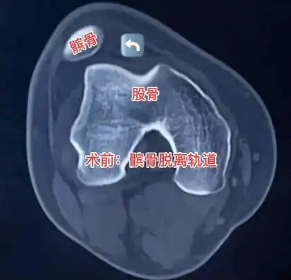 这个患者是个髌骨脱位,我们给他做了内侧髌股韧带重建,脱位完全 - 抖