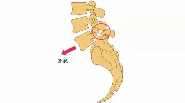 腰椎滑脱,峡部裂了,需要手术吗?