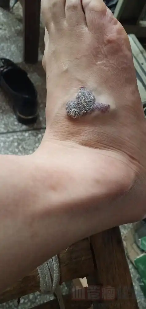 脚上长了血管瘤