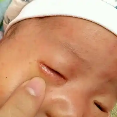 婴儿眼睛湿疹,而且是在眼下皮里,怎麼办?