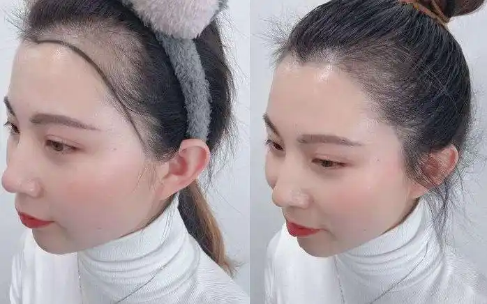 fashion talk 美妆谈发际线后移现在成为很多人不可忽视的问题,同时发