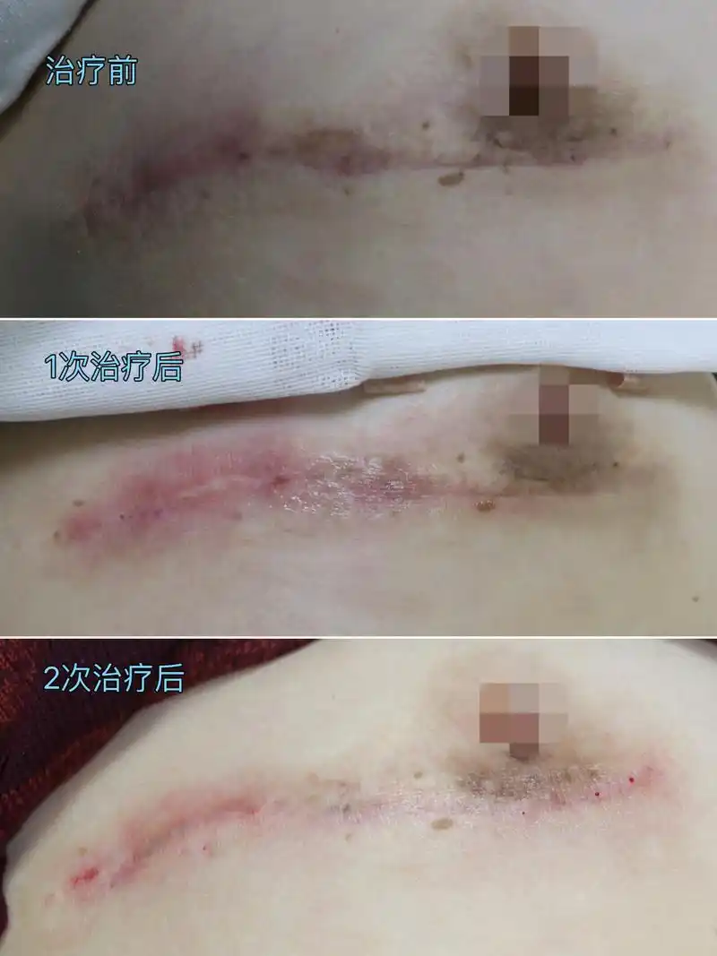 疤痕#  #疤痕修复# #疤痕
